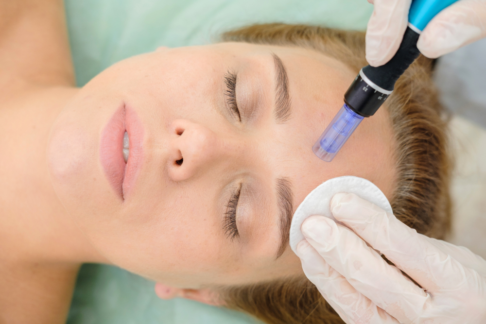 Rf Microneedling Treatment
